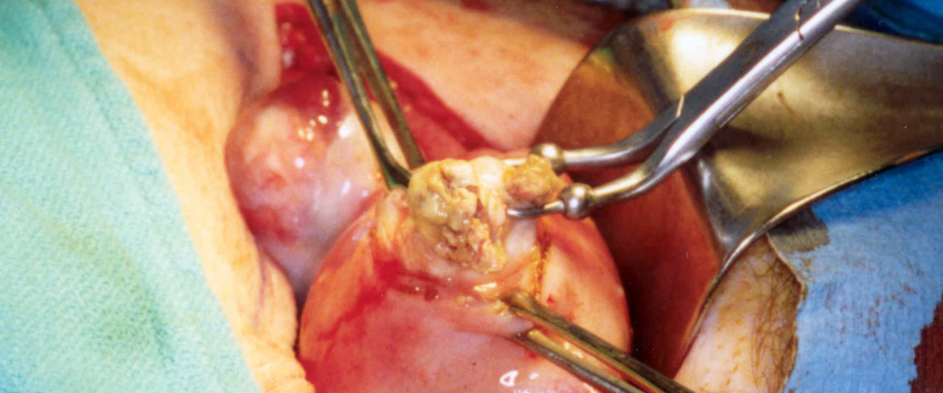 Understanding Uterine Fibroid Removal