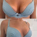 Breast Augmentation: Enhancing Women's Health and Confidence