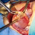 Understanding Uterine Fibroid Removal
