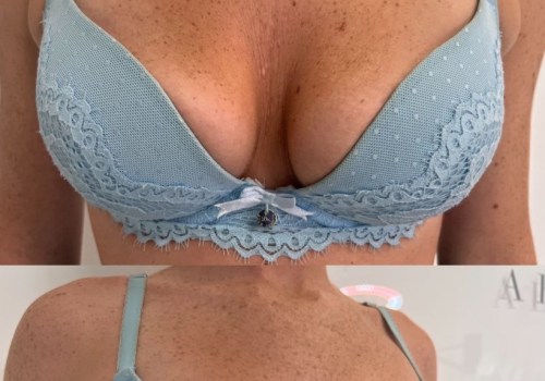 Breast Augmentation: Enhancing Women's Health and Confidence