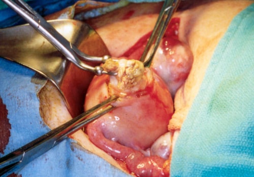 Understanding Uterine Fibroid Removal